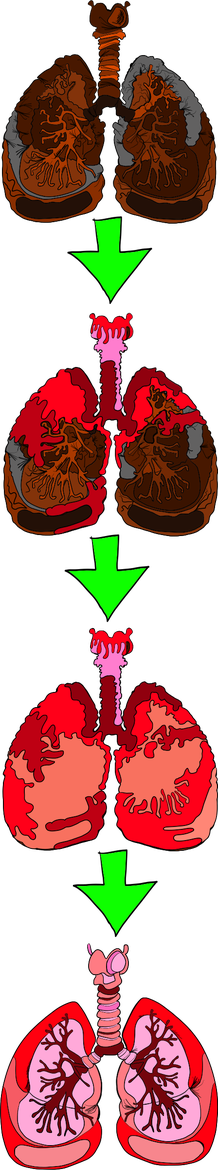 Four stages of lungs being restored, linked by green downward arrows